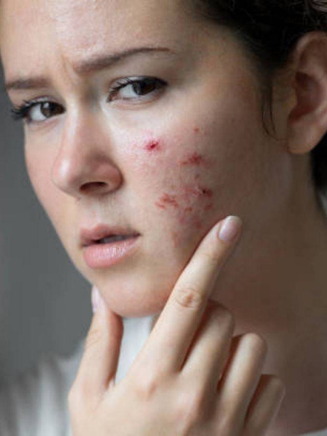 acne pore skin 4